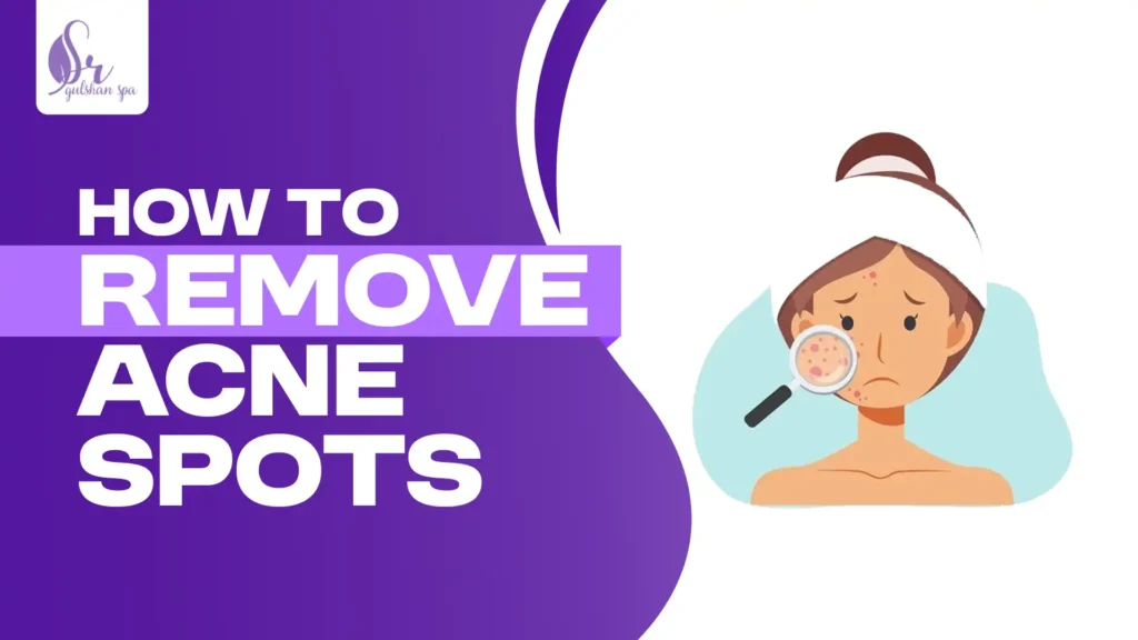 How To Remove Acne Spots